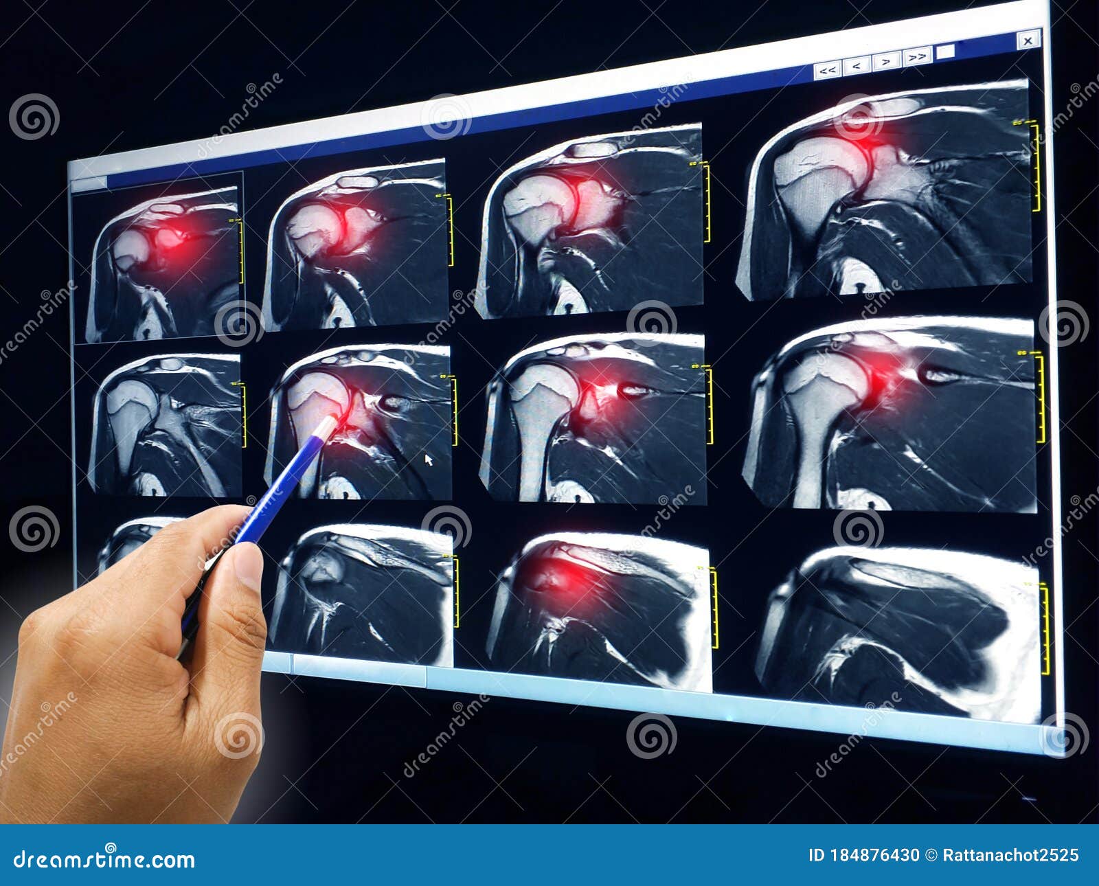 mri of shoulder showing rotator cuff tendon tear