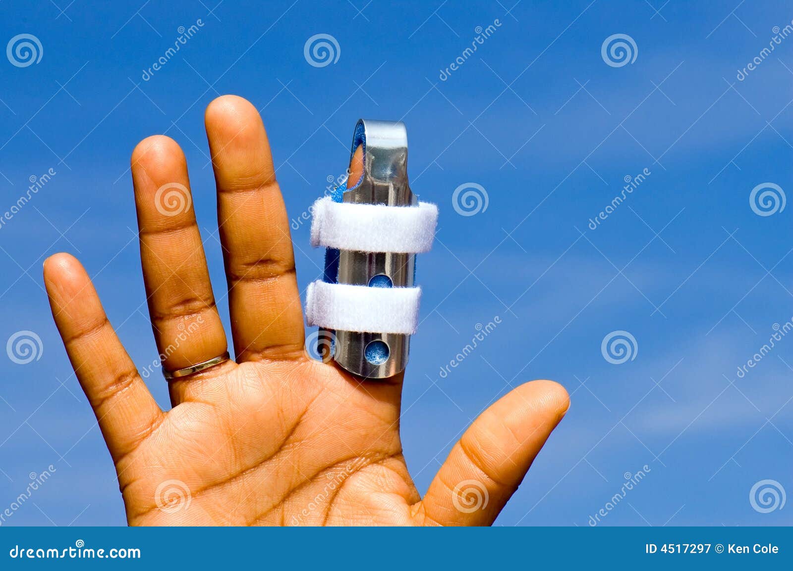 hand with finger in splint