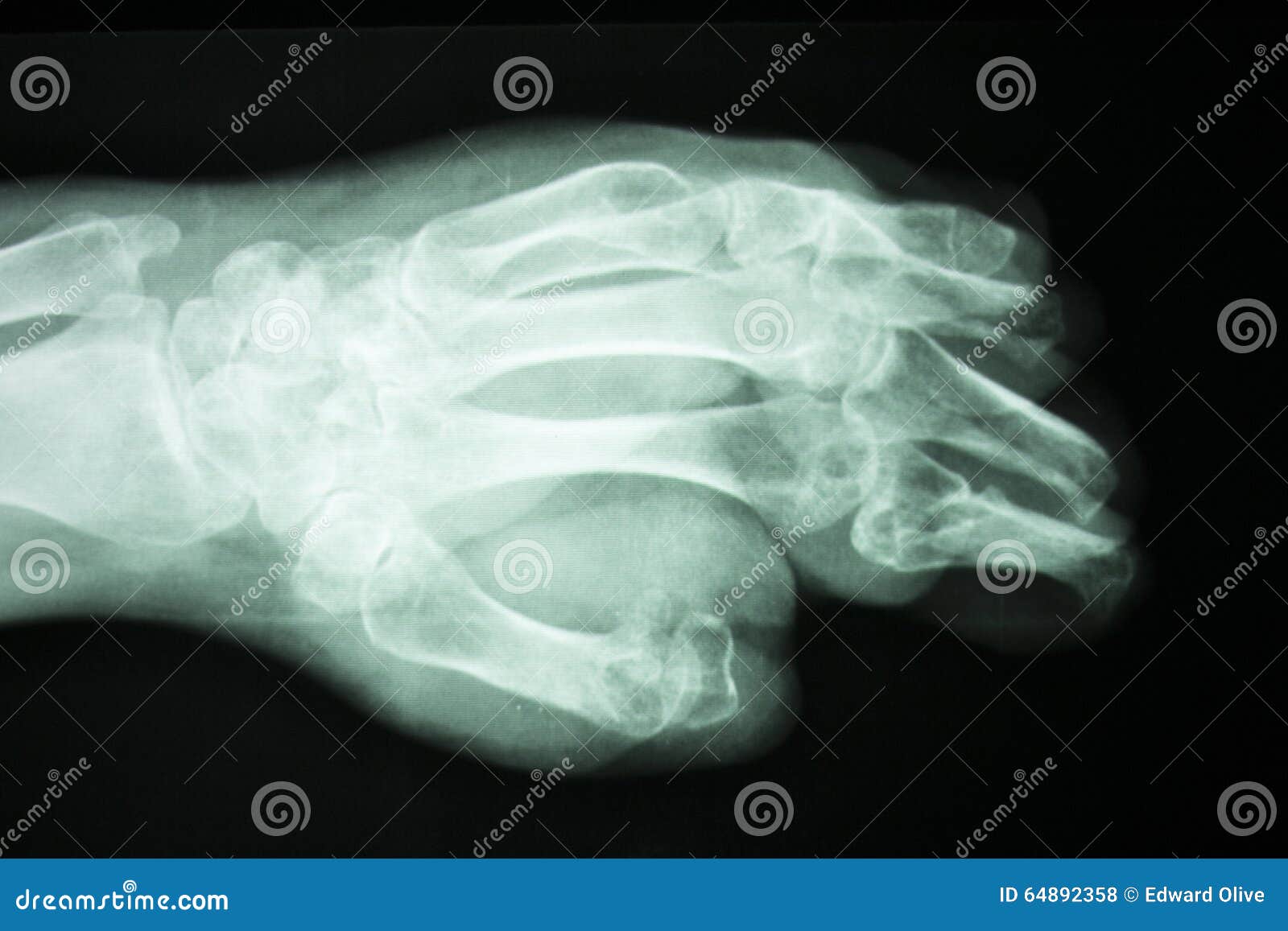 jammed finger xray jammed finger xray