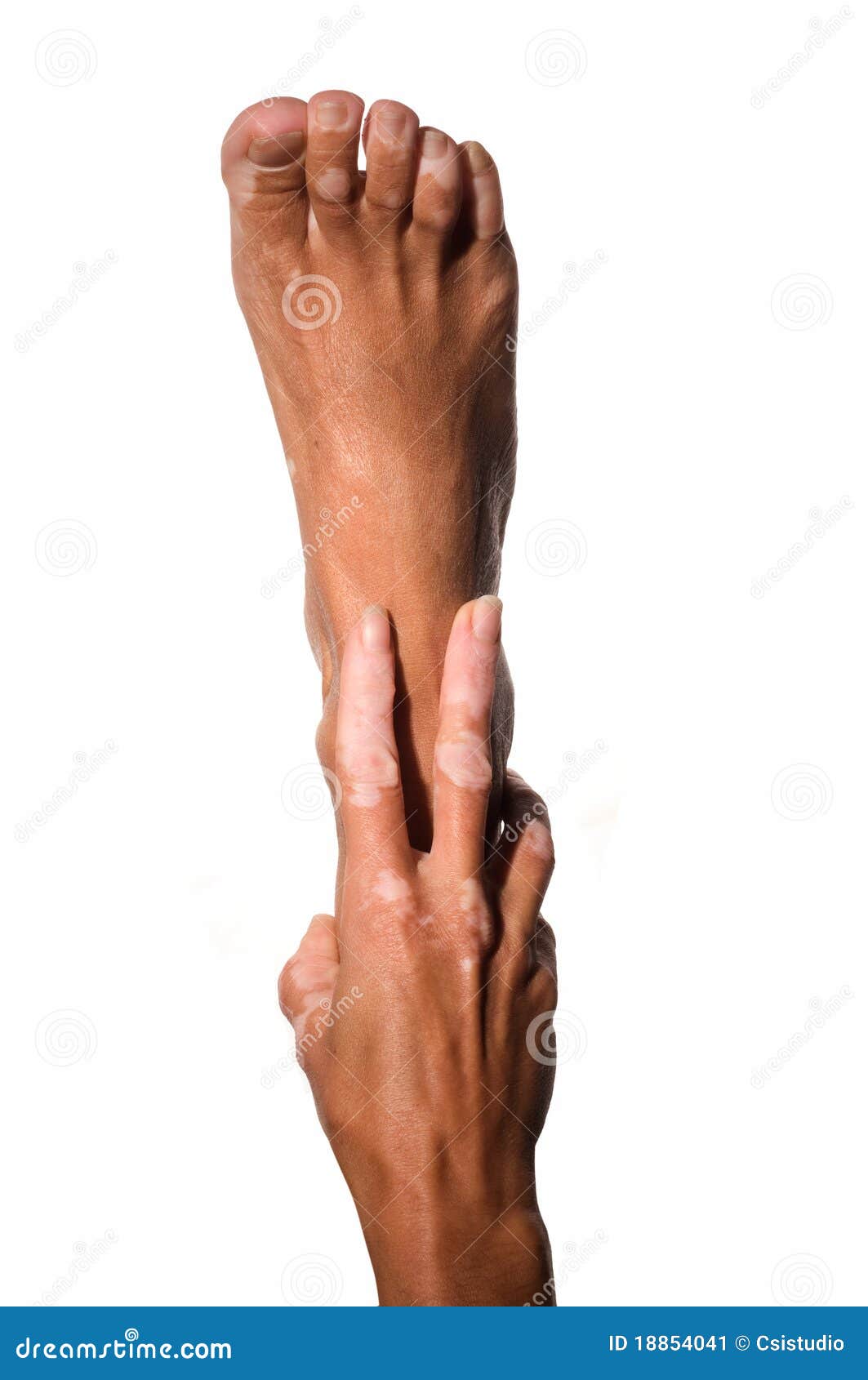 Hand and foot stock image. Image of vitiligo, girl, cancer 18854041