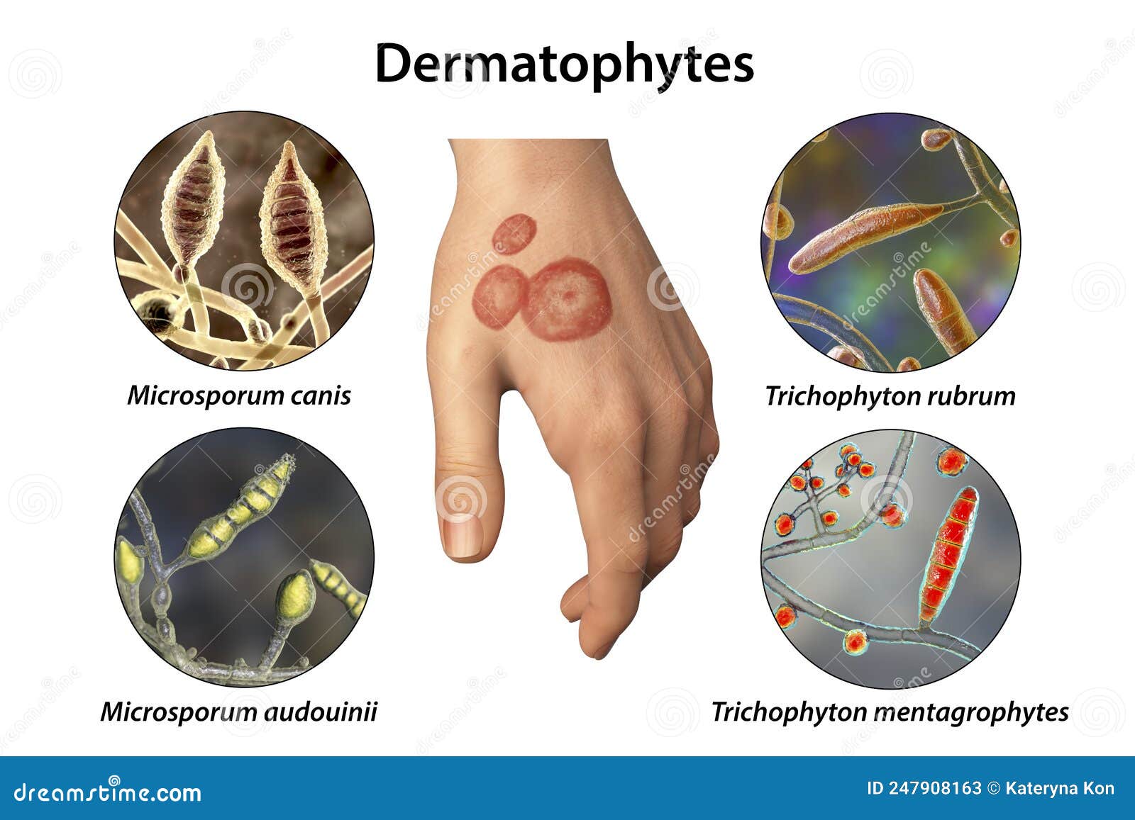 Hand Fungal Infection, Tinea Manuum, 3D Illustration Stock Illustration -  Illustration of dermatophyte, tinea: 247908163