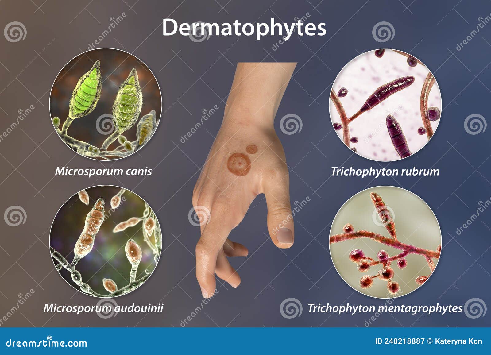 Hand Fungal Infection, Tinea Manuum, 3D Illustration Stock Illustration -  Illustration of human, fungi: 248218887