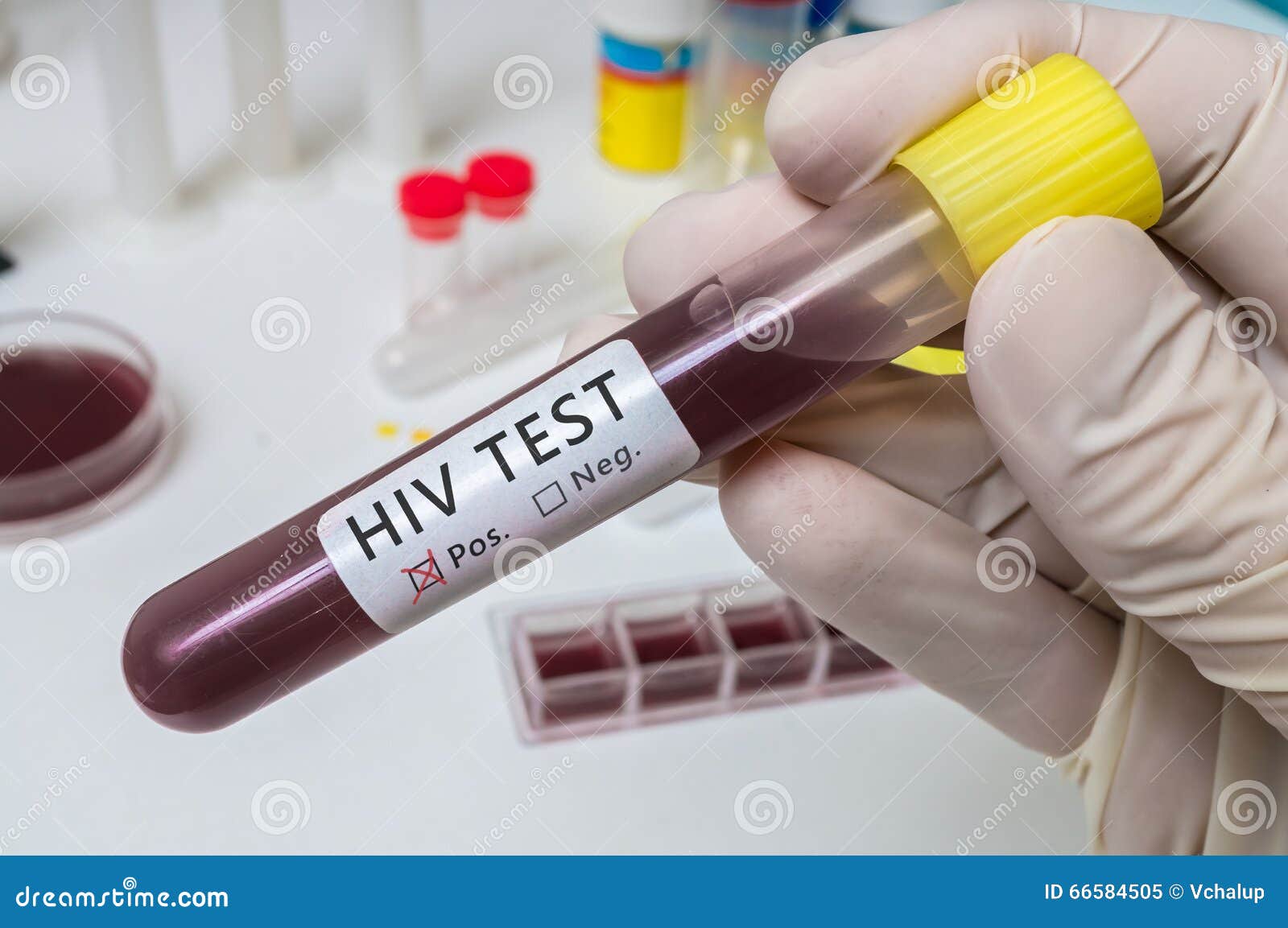 Hand Holds Test Tube for HIV Test Stock Image Image of medical, human