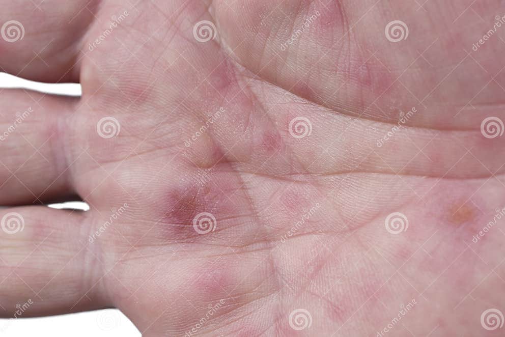 Hand, Mond En Klauw Ziekte Stock Foto Image of behandeling, volwassen 78314626