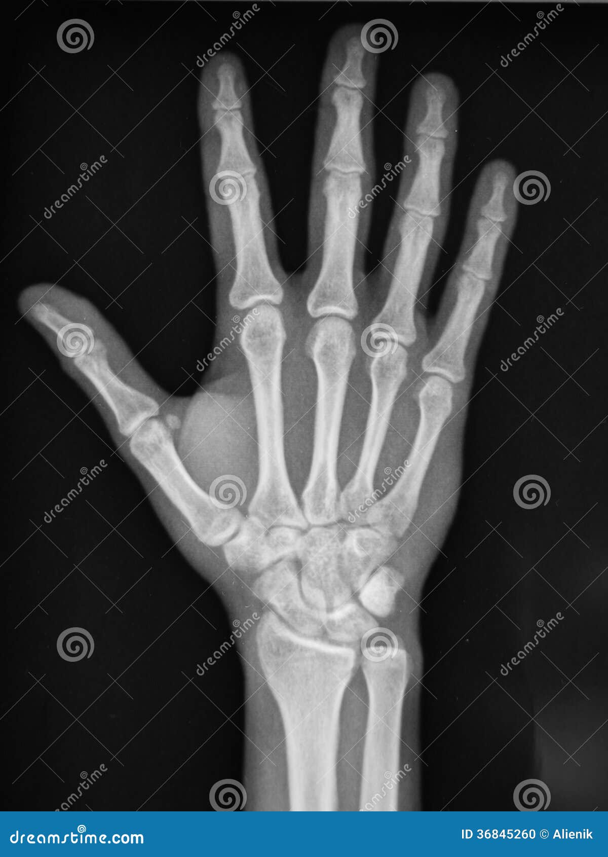 hand radiography