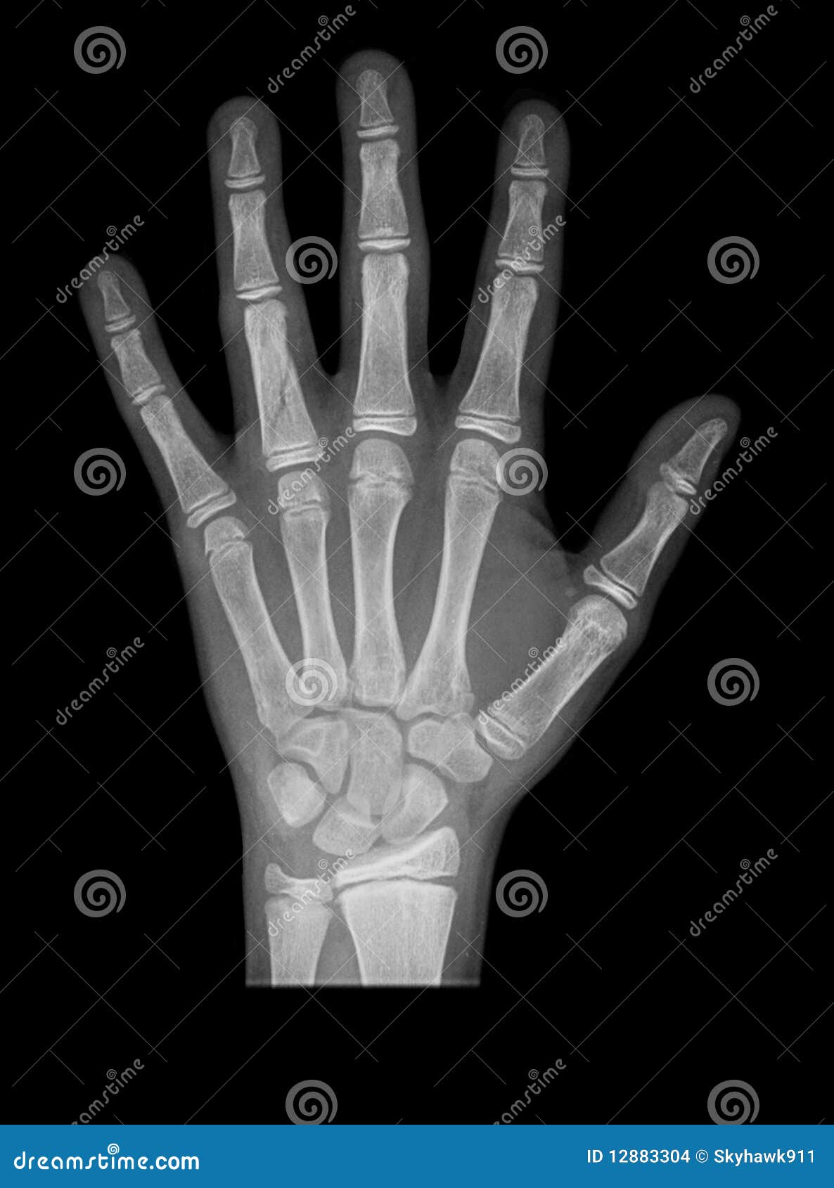 Hand xray stock photo. Image of finger, body, examination 12883304