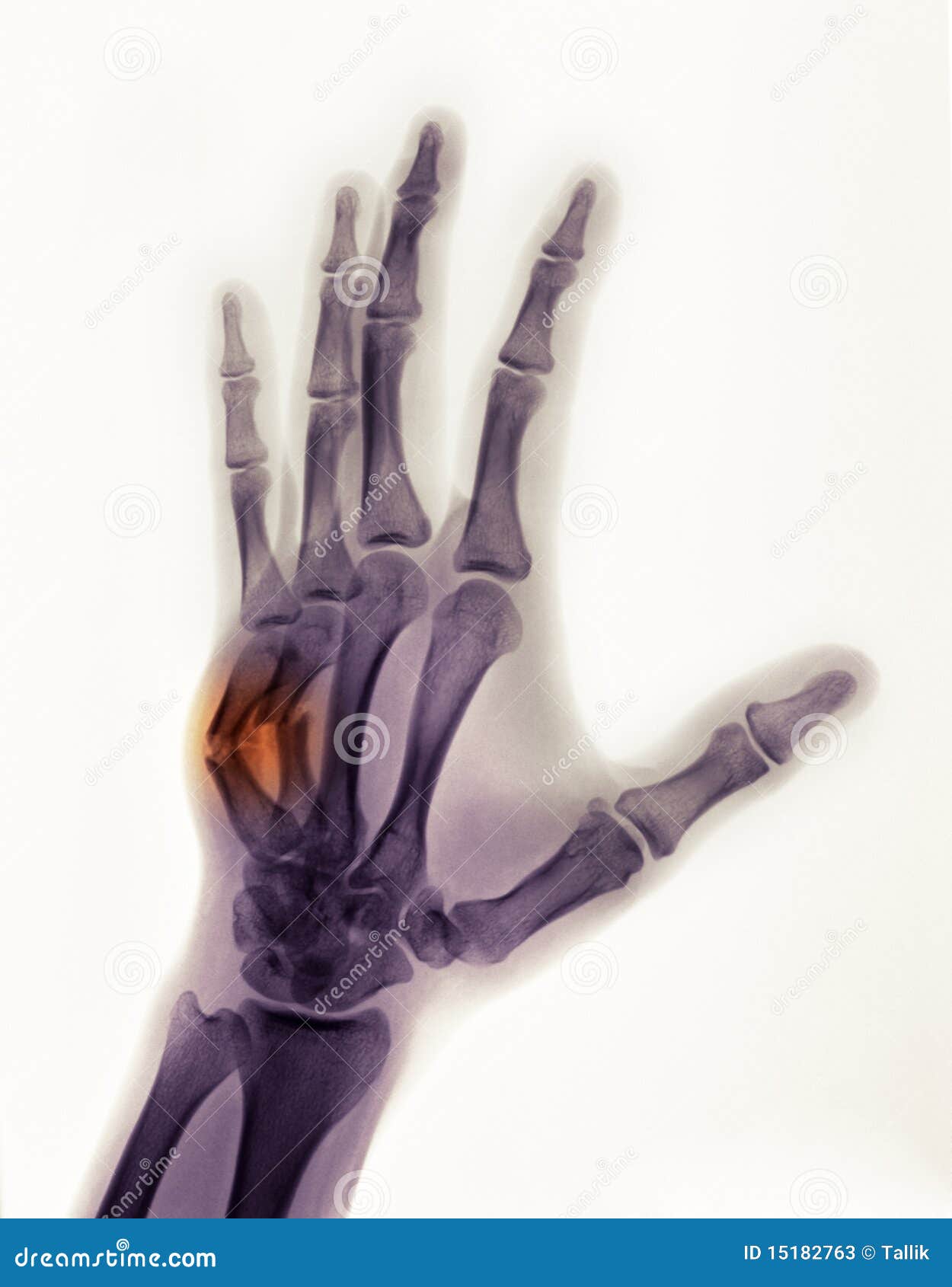 Hand Xray Showing a Boxer S Fracture Stock Image Image of accident