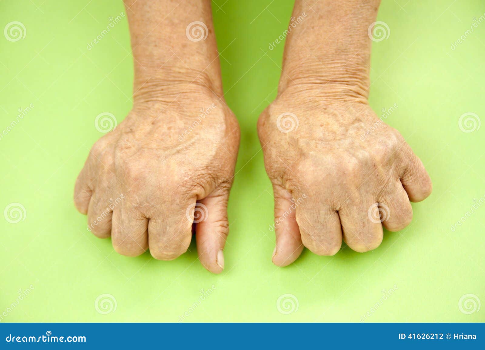 misshapen finger joints misshapen finger joints