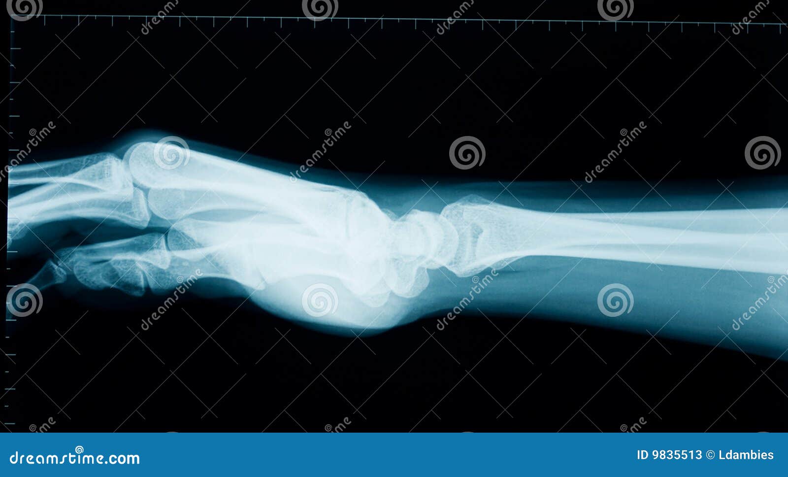 hand wrist x-ray