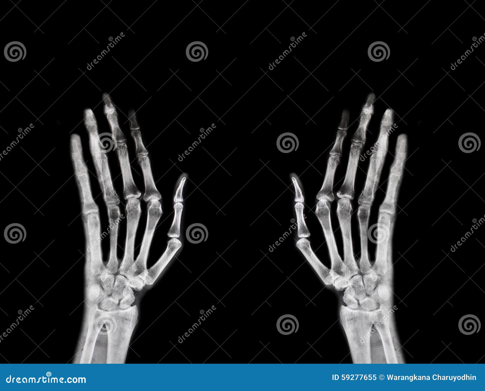 hand x ray clipart - photo #47