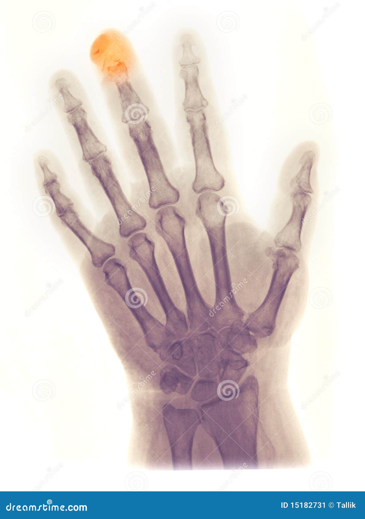 hand x-ray, fractured/amputated distal phalanx