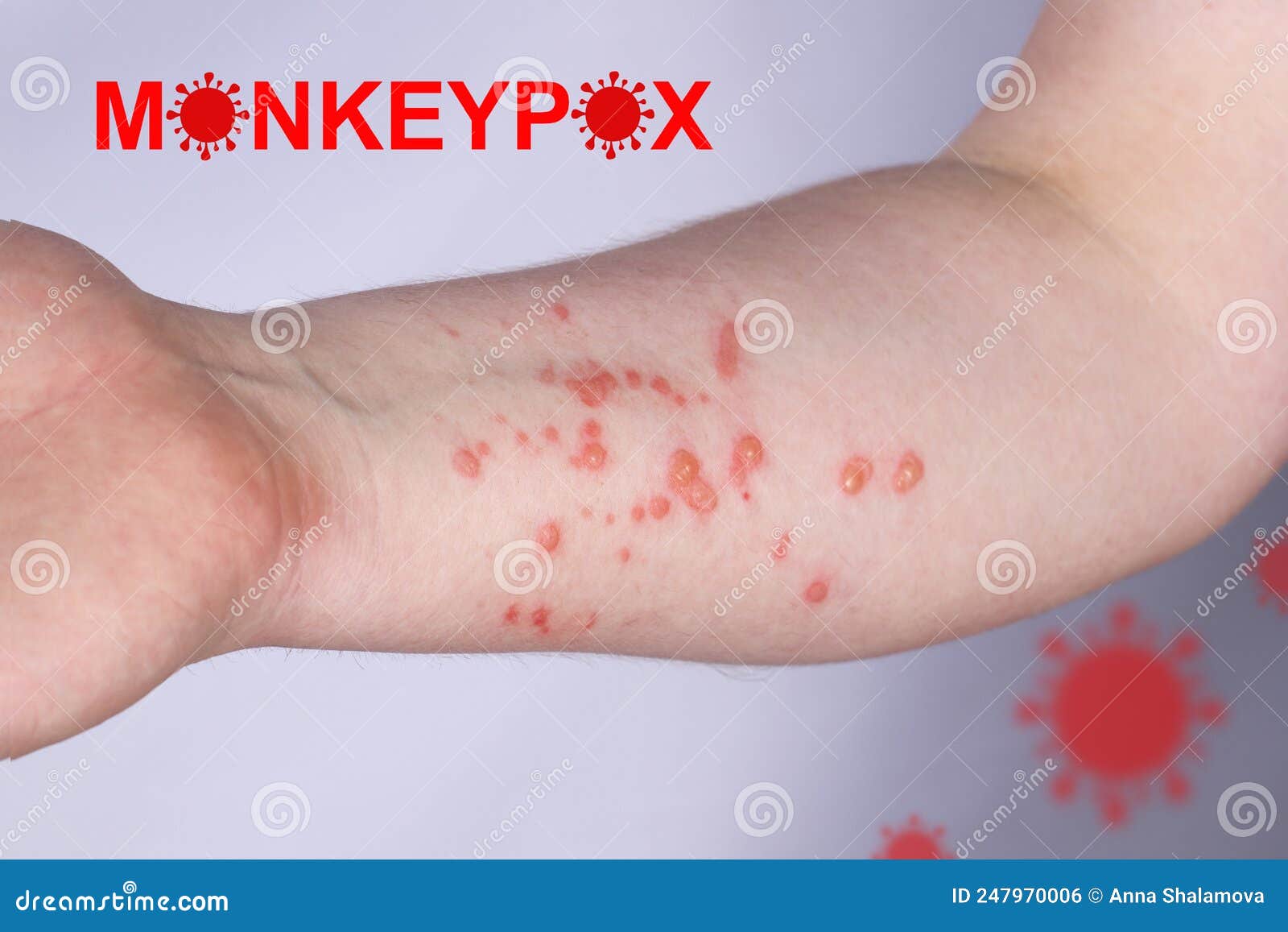 hand of a young guy in a rash. monkeypox virus symptoms