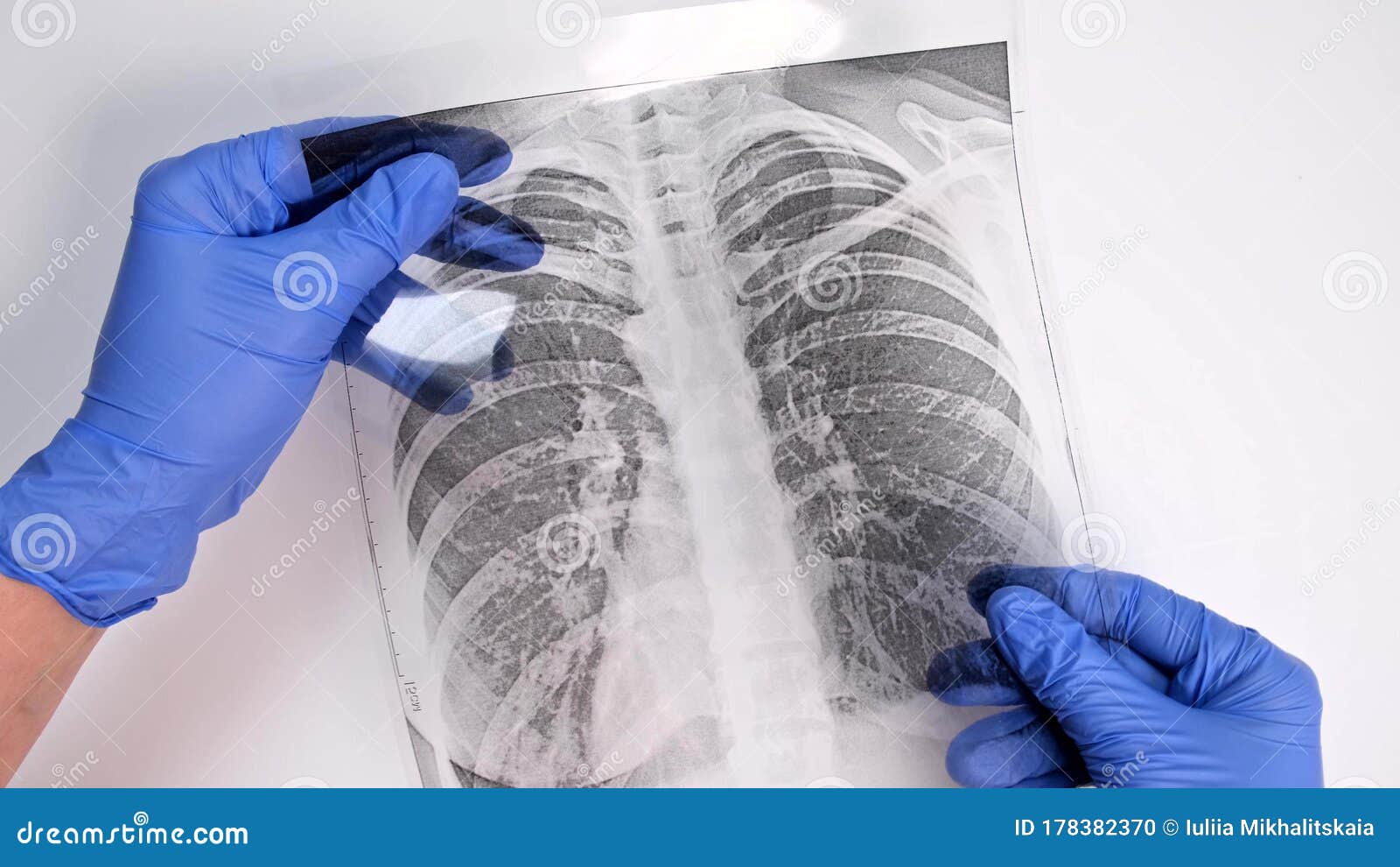 hands of a doctor in blue gloves examining, checking fluorography, x-ray of a patient during epidemia, pneumonia and bronchitis