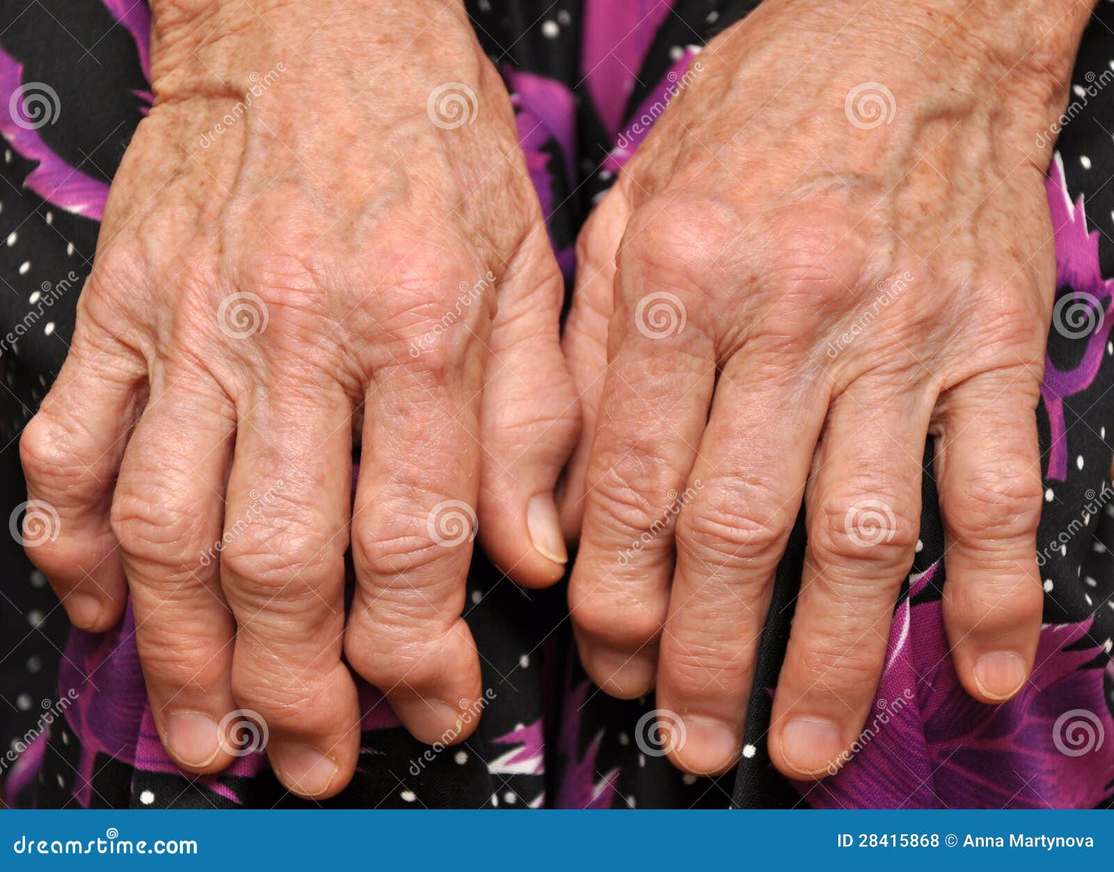 Ревматоидный артрит суставов кистей. Ревматоидный артрит полиартрит. Псориазный ревматоидный артрит. Деформирующий ревматоидный полиартрит. Ревматоидный полиартрит рук.