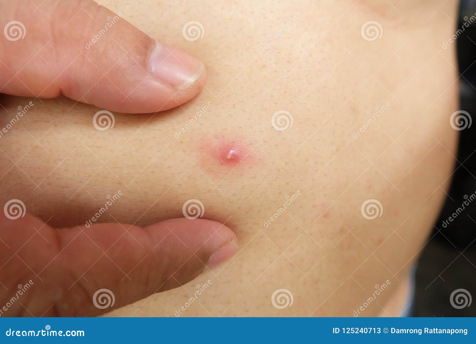 Hands Are Squeezing Acne Or Pimple Stock Image Image Of Face Detail 125240713