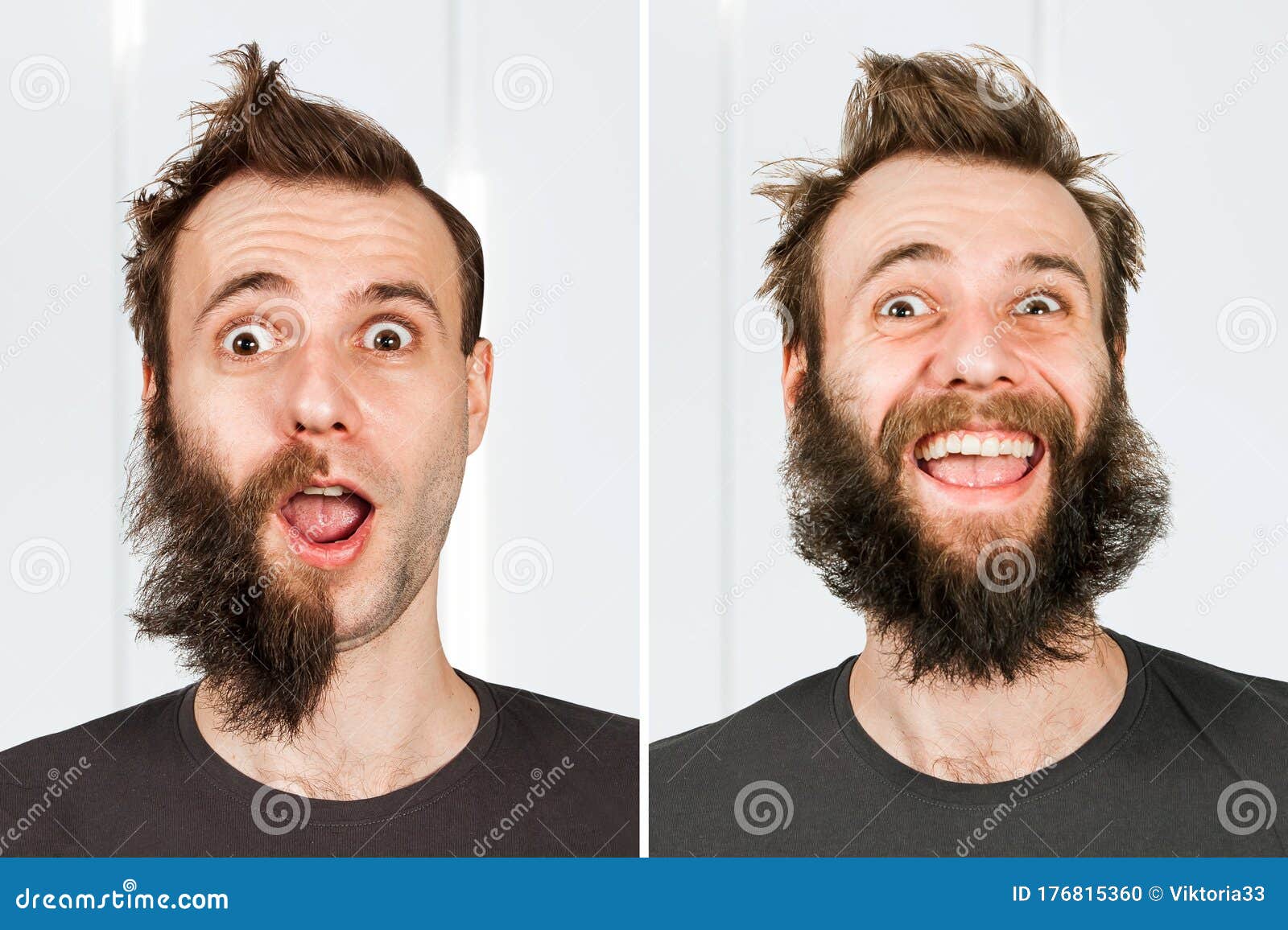 Happy Guy With Half Beard And Without Hair Loss Man Before And After Shave Or Transplant Haircut Set Transformation Stock Photo Image Of Head Loss