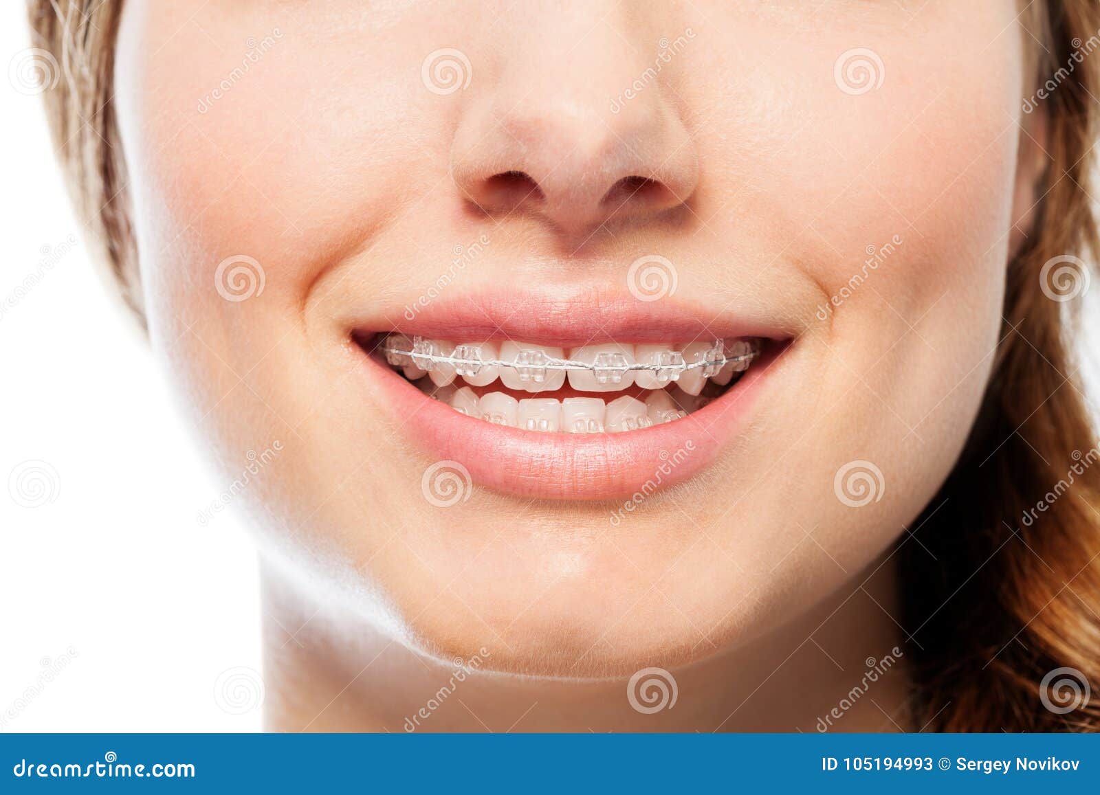 happy woman`s smile with orthodontic clear braces