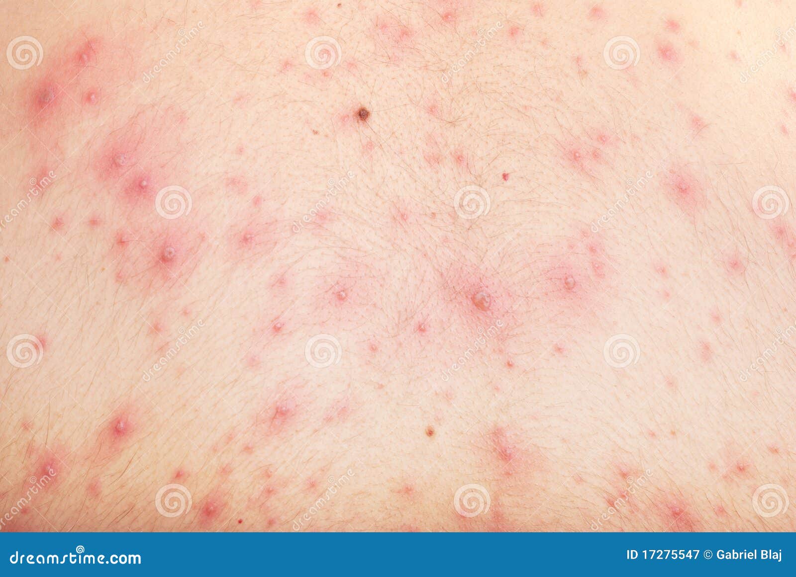 Chickenpox (Varicella) Photos - Vaccine Information You ...