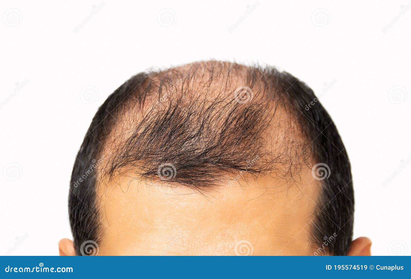 Head of Bald Man on White Background Stock Image - Image of balding, flaking: 195574519 Head of Bald Man on White Background Stock Image - Image of balding, flaking: 195574519