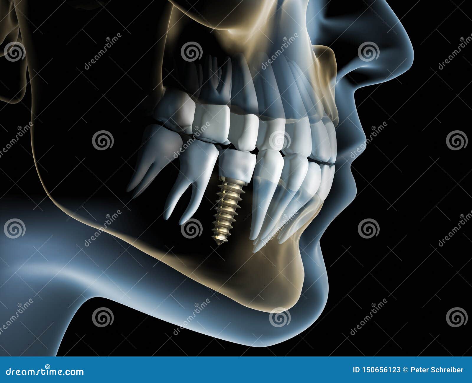 head and jaw with a dental implant