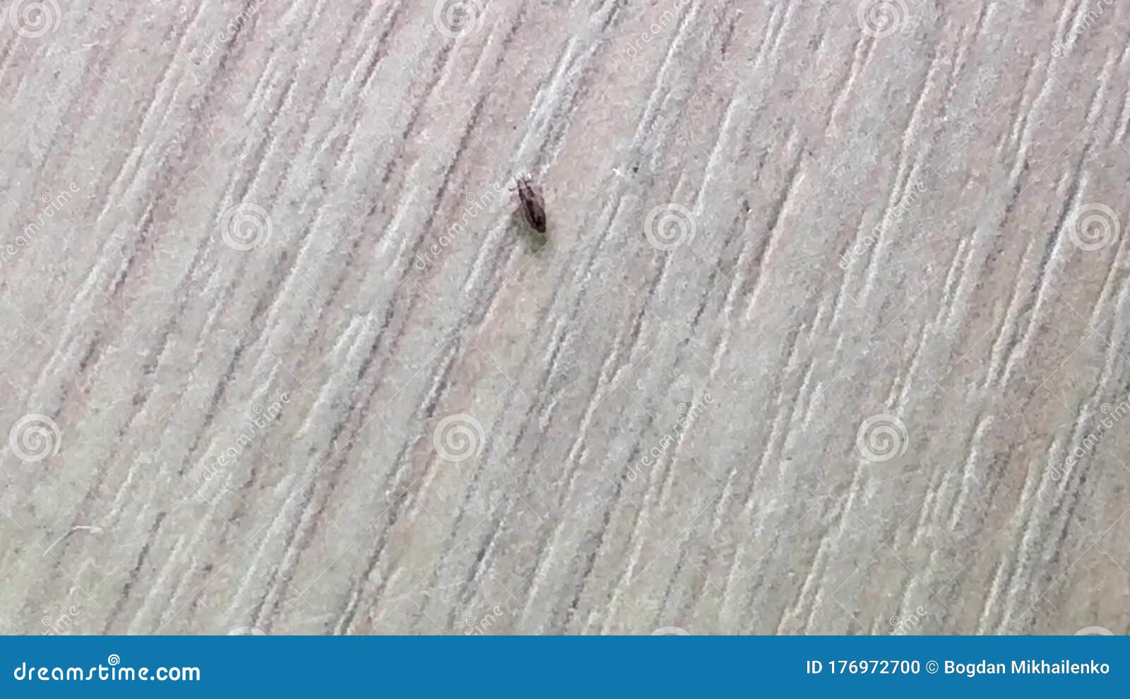 Head Lice are a Human Parasite Stock Footage Video of parasite, head