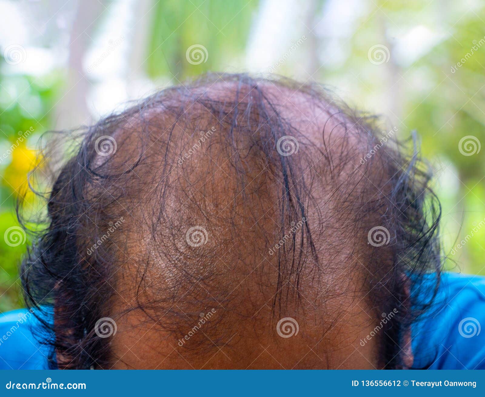 Hair Loss in Women Causes Treatment  Prevention