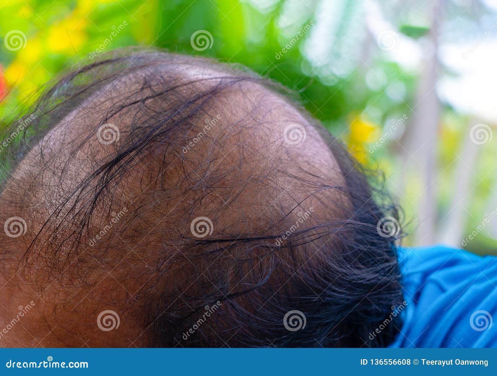 A patch of hair thinning on the frontal area of the scalp without scale   Download Scientific Diagram