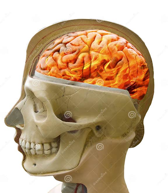 Headache Anatomy Of Pain Burning Brain In Fire Stock Photo Image Of