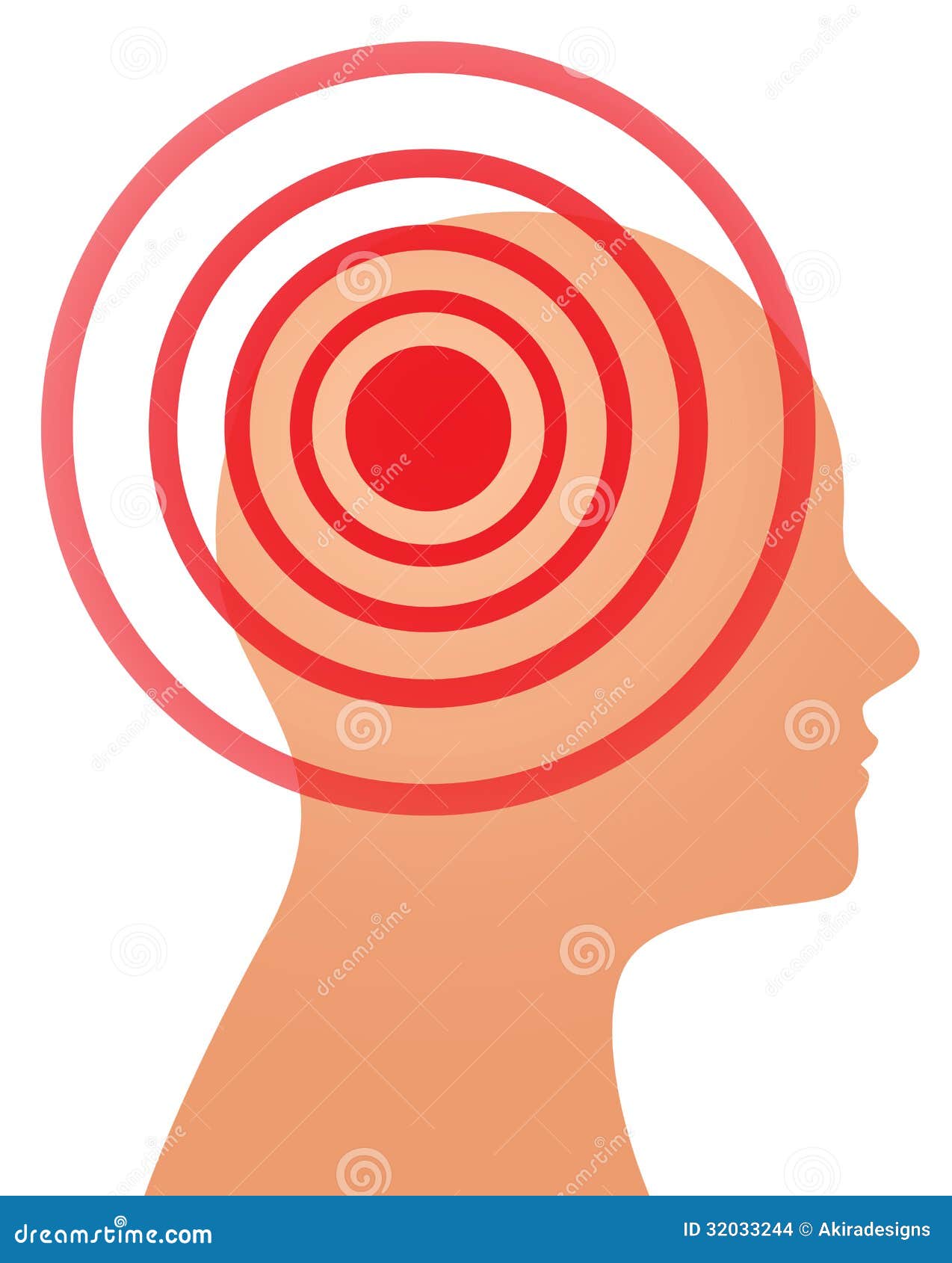 Headache, Migraine, Stroke, Conceptual Illustration Showing A Woman