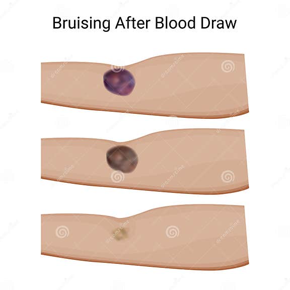 Healing Bruise Progression Post Blood Draw Stock Illustration