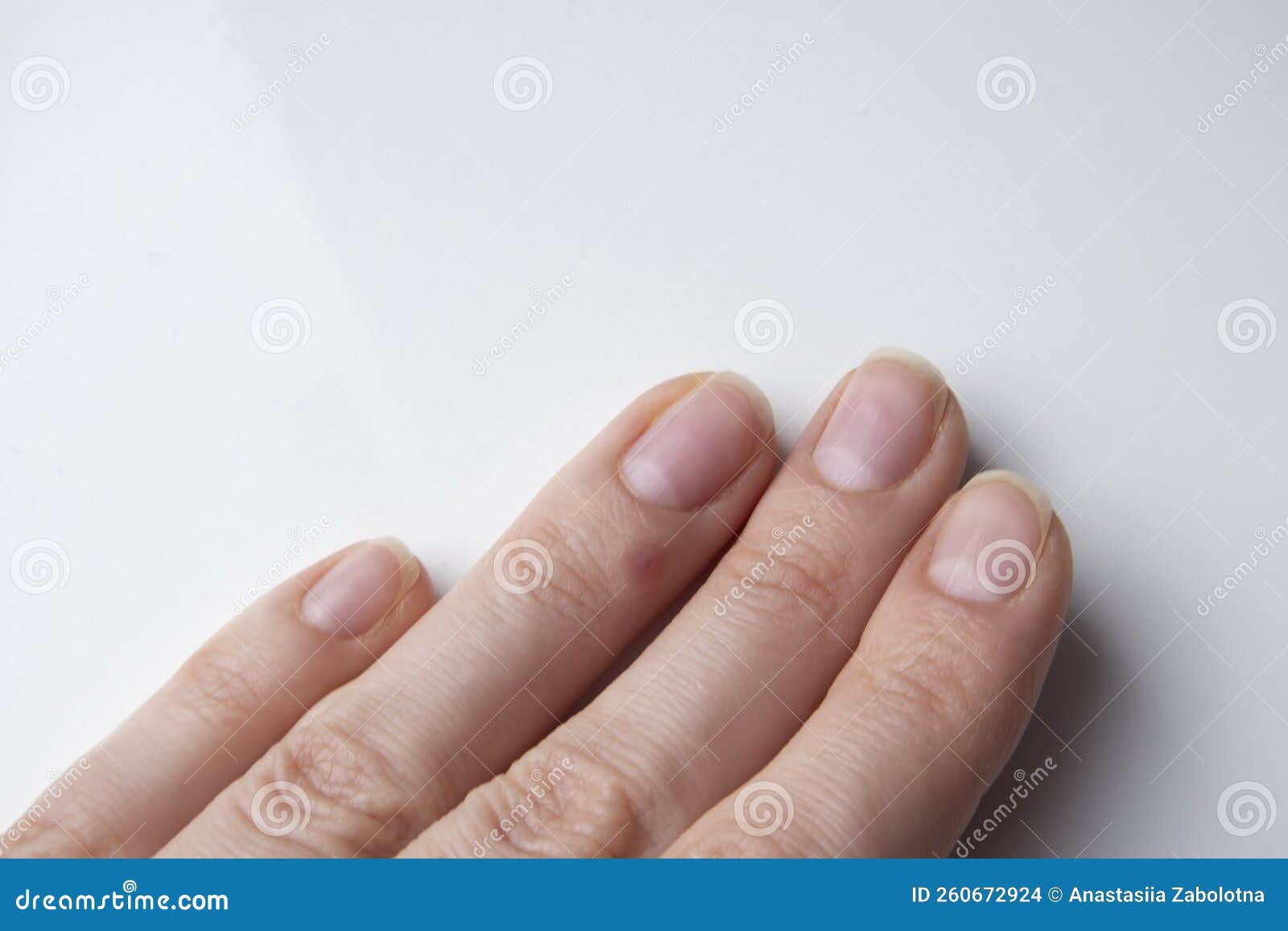The Healing Process of a Wart on a Girl& X27;s Finger. Stock Photo