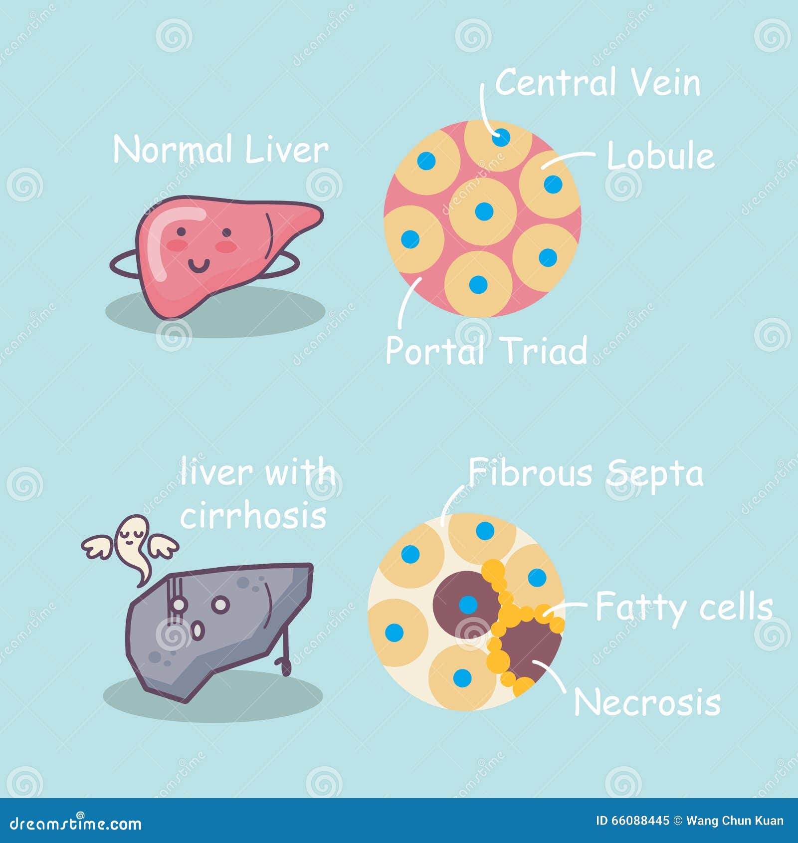 health liver vs cirrhosis liver