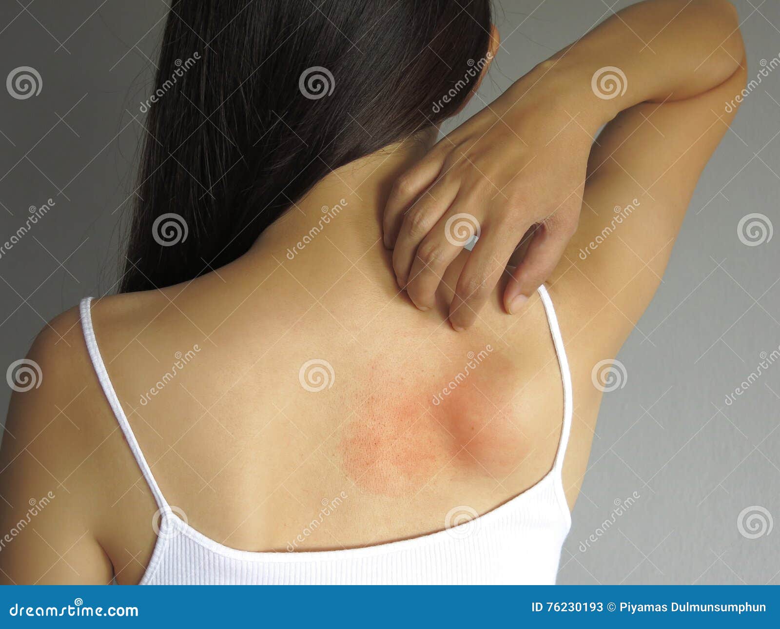 health problem. woman scratching her itchy back with allergy rash