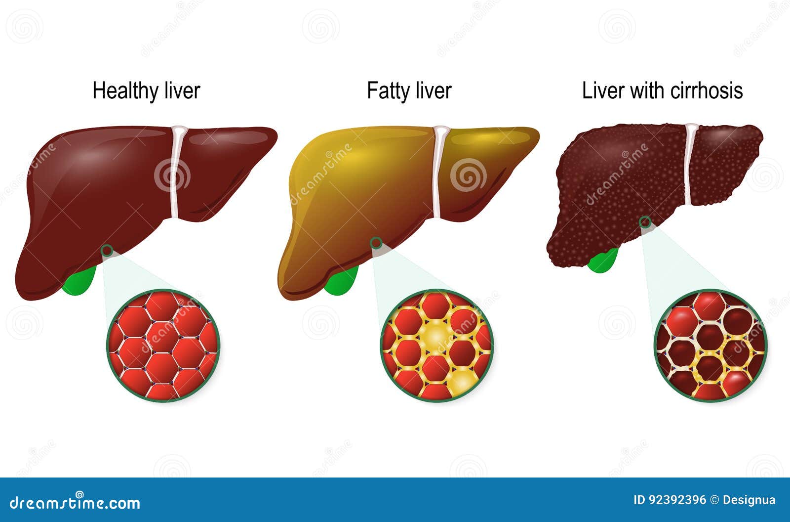 healthy, fatty and cirrhosis of the liver