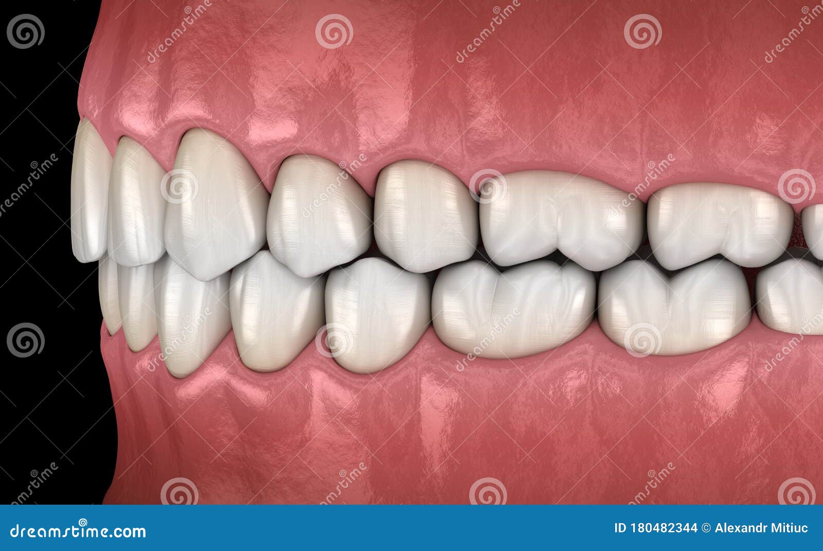 Healthy Human Teeth with Normal Occlusion, Side View. Medically