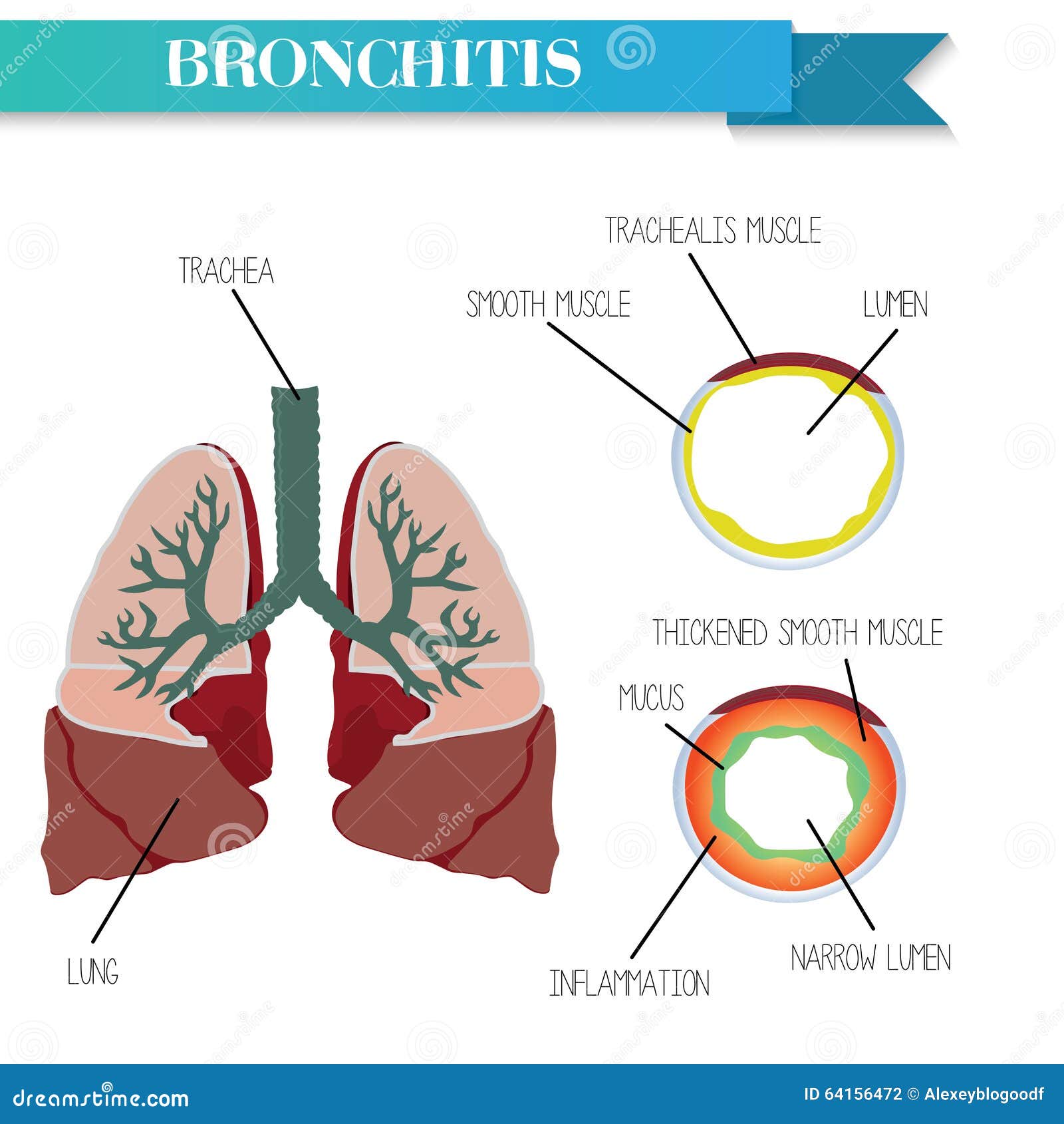 healthy and inflamed bronchus. chronic bronchitis.