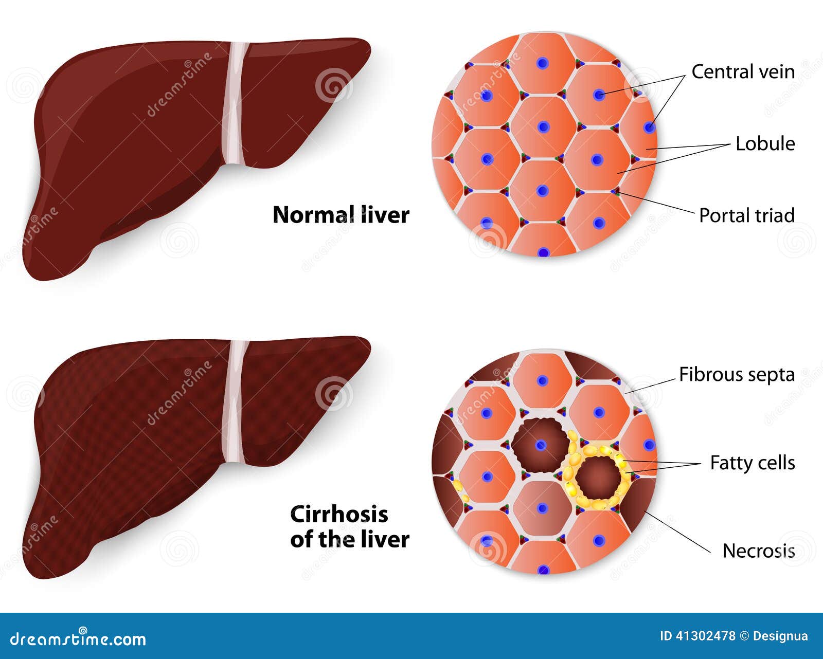 healthy liver and cirrhosis