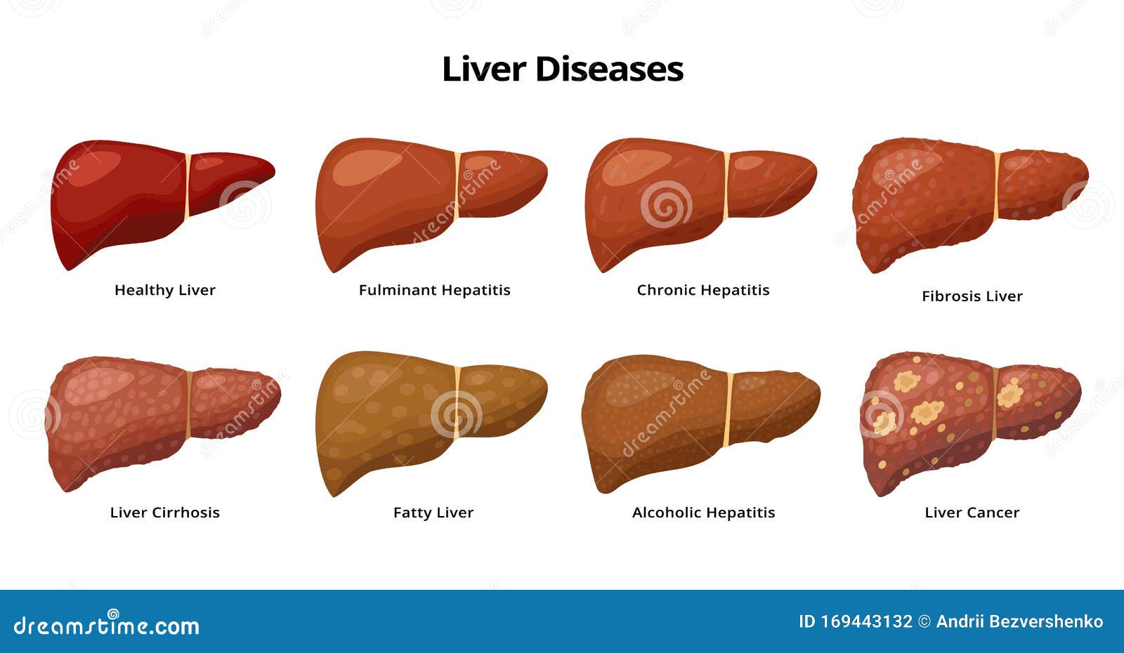 healthy liver and liver diseases - fatty liver, hepatitis, fibrosis, cirrhosis, alcoholic hepatitis, liver cancer -