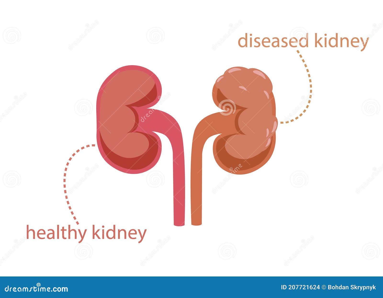 healthy and painful kidney clipart. pink clear parenchyma working organ and gray tumor covered ureter.
