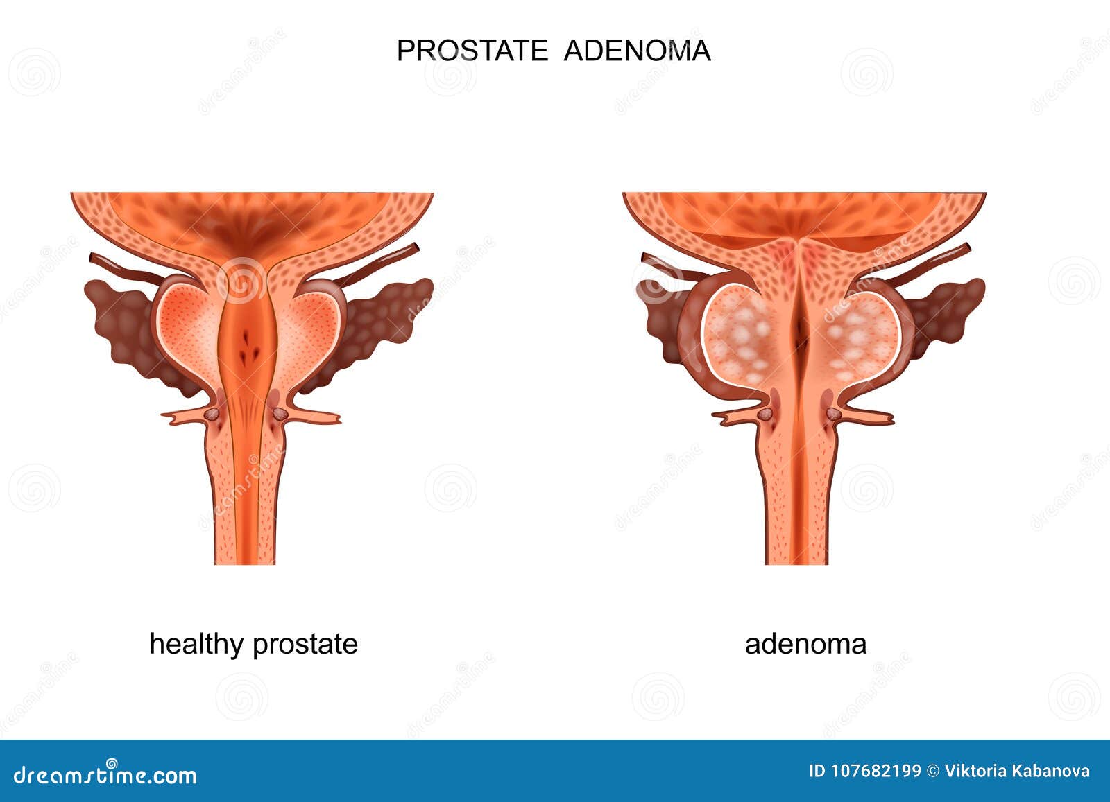 Prostata mărită de volum - recomandări și tratament