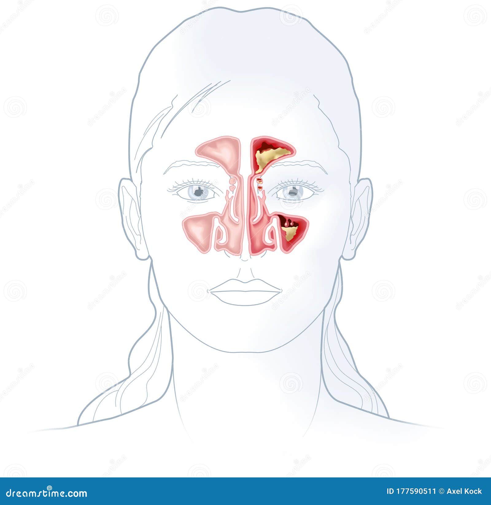 healthy sinus and sinusitis, medical 
