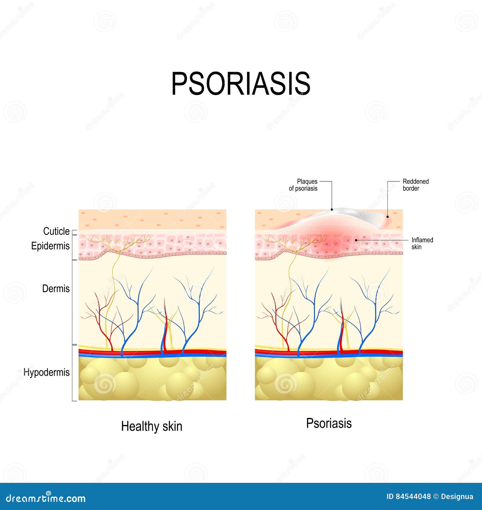 healthy skin close up and skin with the plaque psoriasis