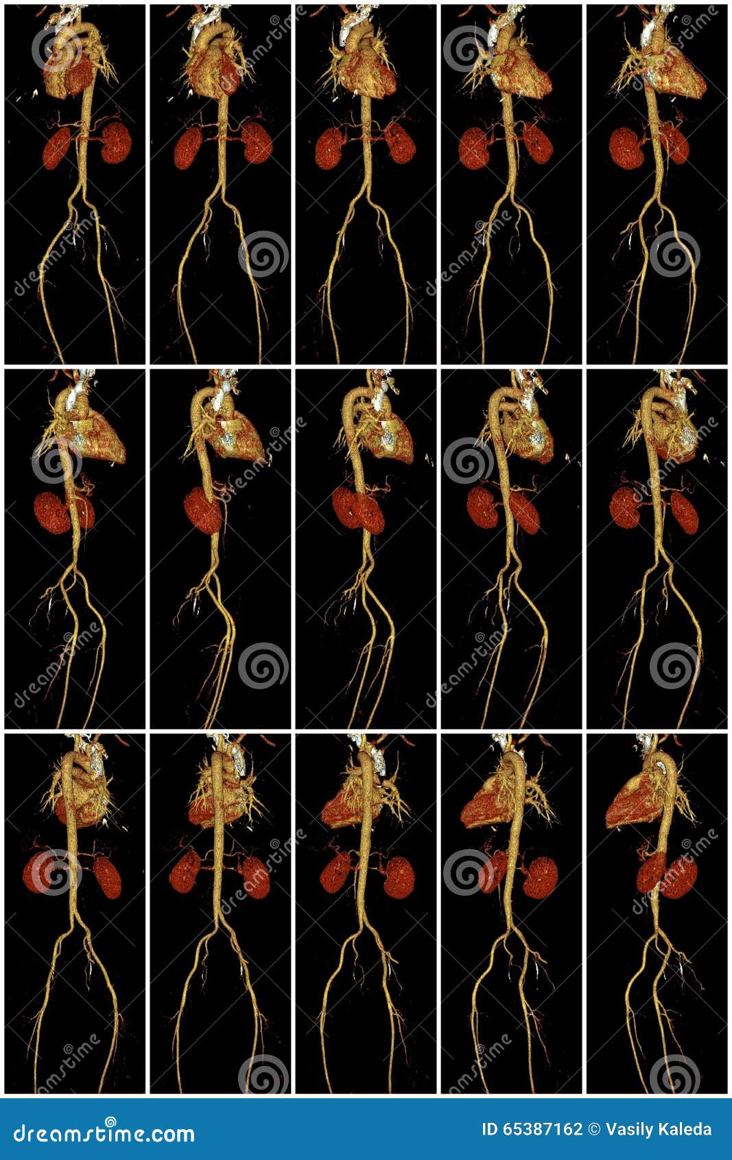 Heart, Aorta and Kidneys on Computed Tomography Stock Photo Image of