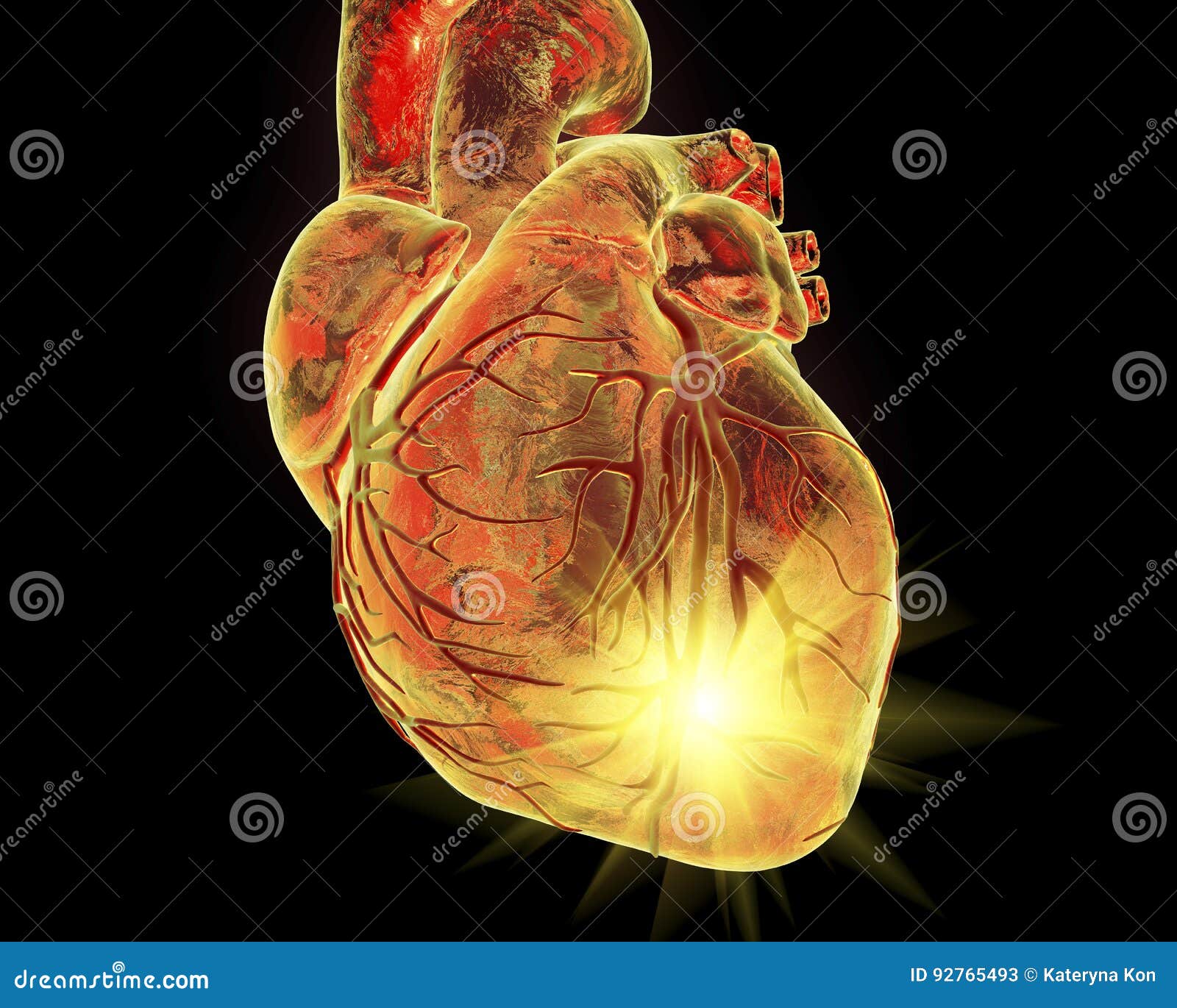heart attack, coneptual 