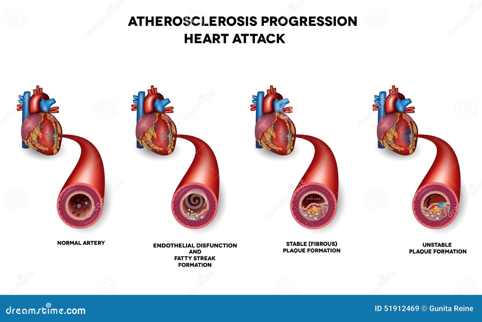 heart attack, coronary artery disease