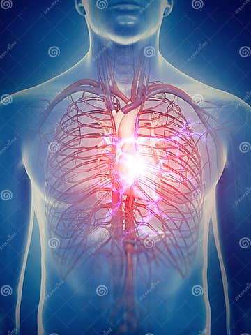 A heart attack stock illustration. Illustration of anatomical - 75188496