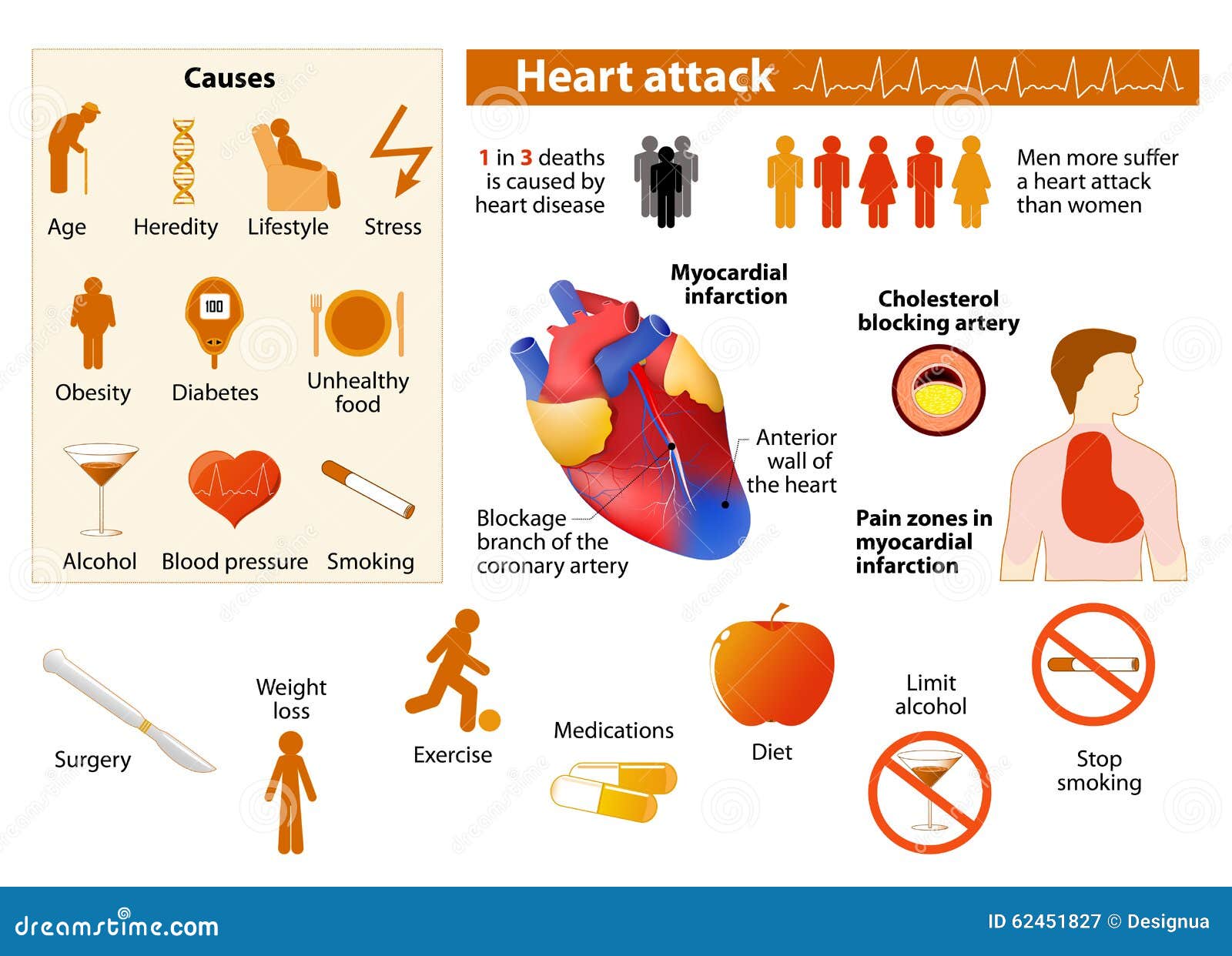 Heart attack infographics in low color style. icon and object Heart disease factors. Medical Infographic set elements and symbols for design.