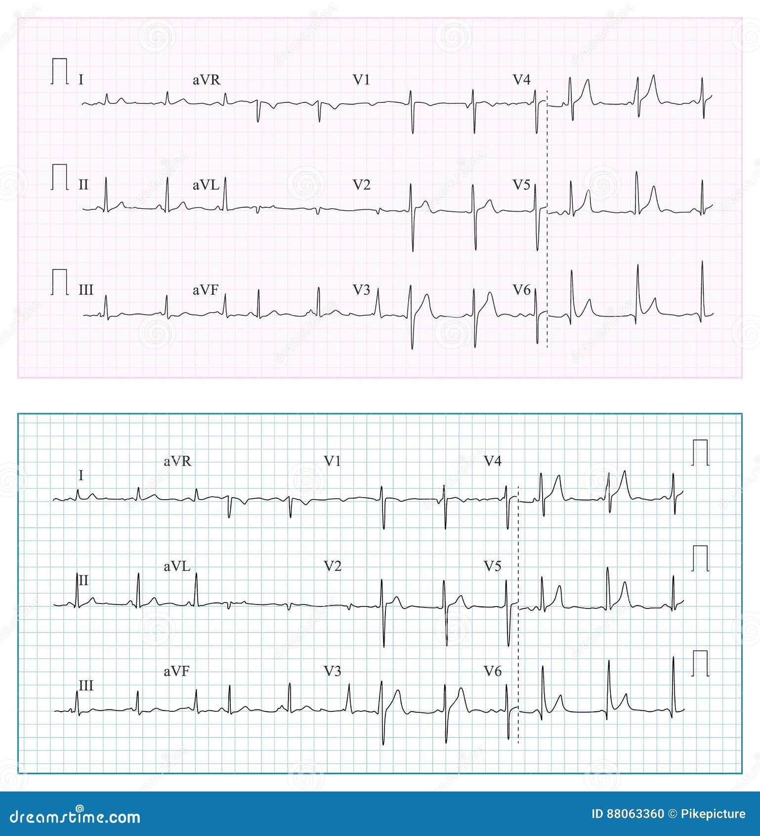 Heart Rhythm Chart