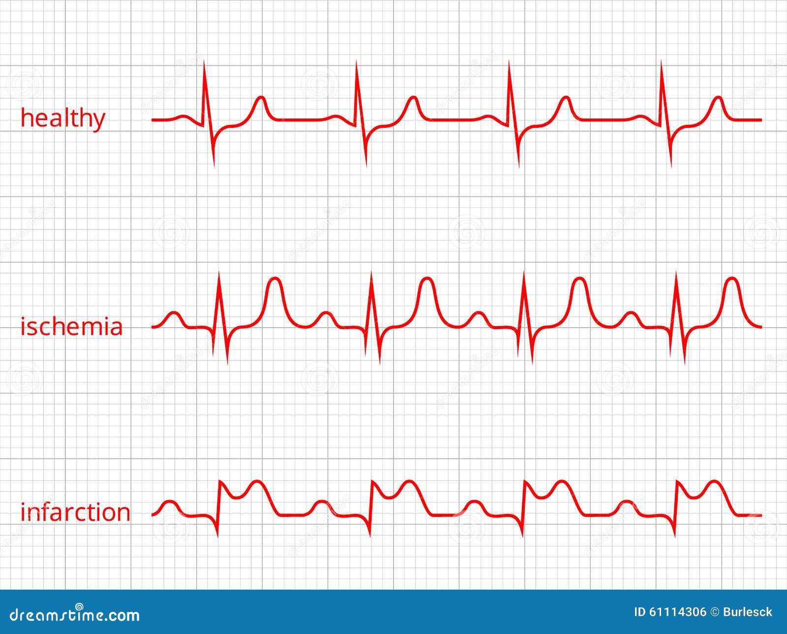 Udled buket Knogle Heart Cardiogram Vector Charts Set. Healthy Heart Stock Vector -  Illustration of infarct, design: 61114306