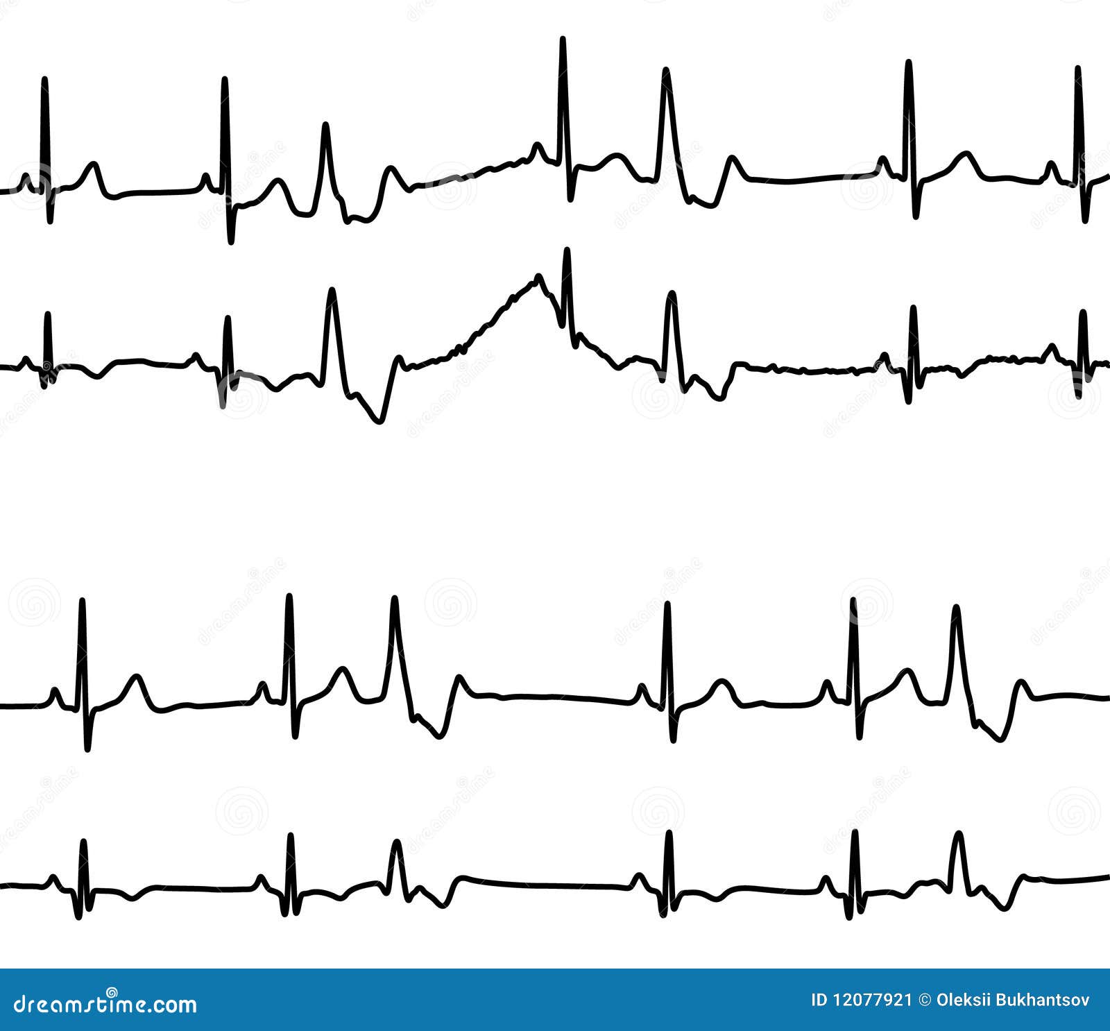 Bigeminy Stock Illustrations 2 Bigeminy Stock Illustrations, Vectors